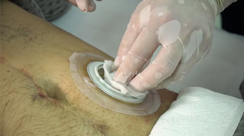 Çift Parçalı Stoma Torba Adaptör Değişimi 